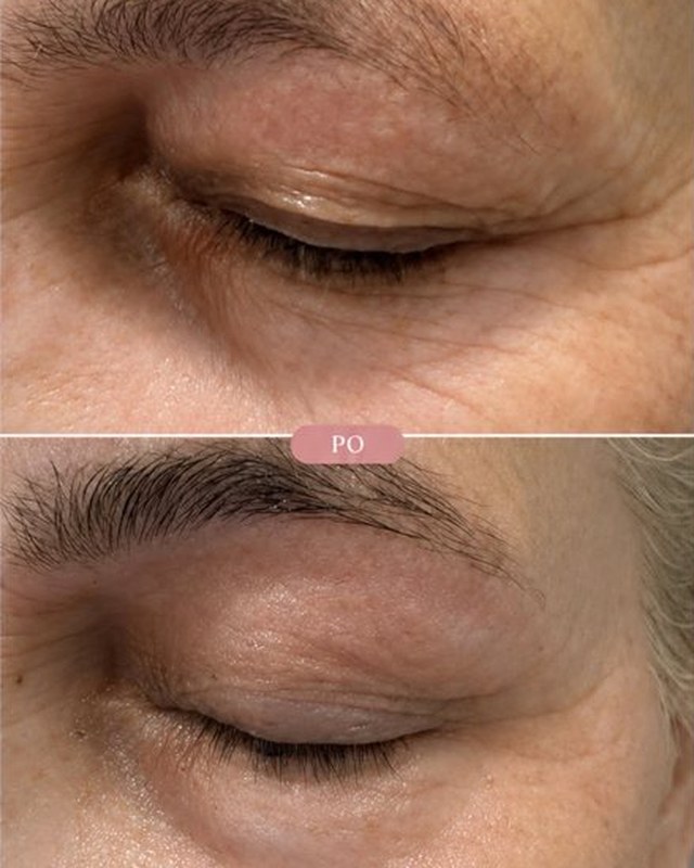 Lifting powiek Plazma ARC w Laser Clinic Radom, zdjęcia przed i po zabiegu