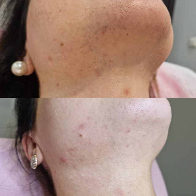 Depilacja laserowa brody LightSheer w Laser Clinic Radom, efekt po 3 zabiegach