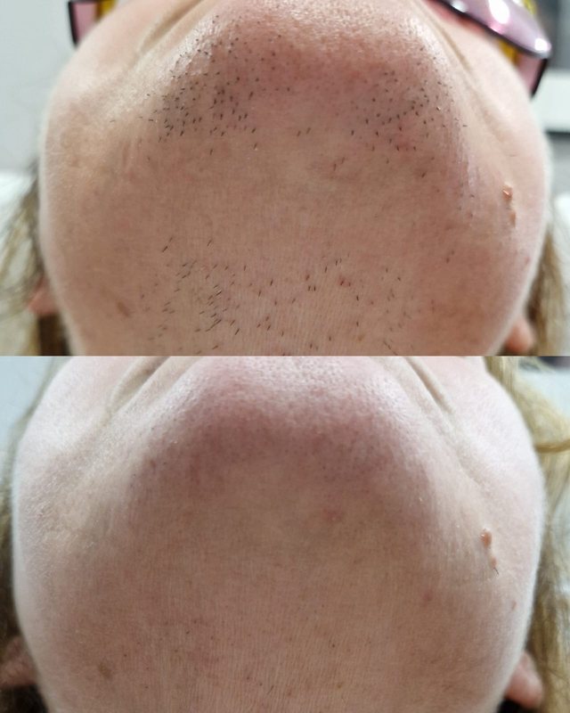 Depilacja laserowa podbródka LightSheer w Laser Clinic Radom, efekt po 3 zabiegach