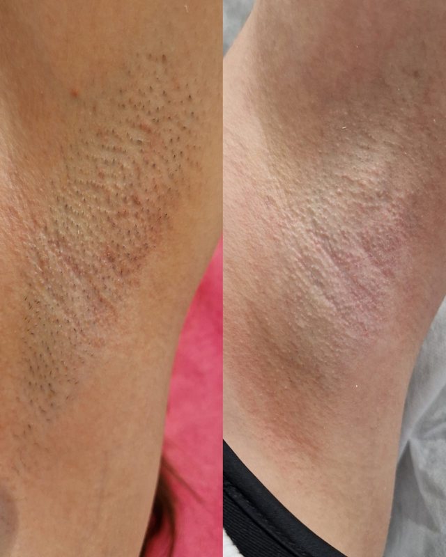 Depilacja laserowa pach LightSheer w Laser Clinic Radom, przed i po 3 zabiegach