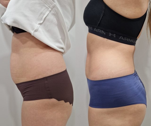 Endermologia LPG na brzuch w Laser Clinic Radom, efekt po serii zabiegów