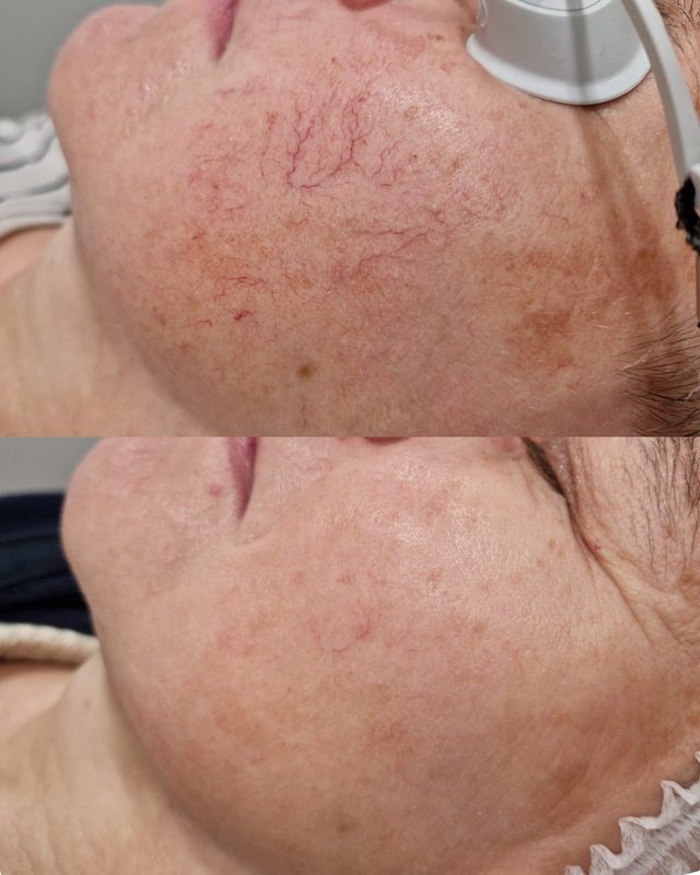 Naczynka na policzku przed i po 3 zabiegach światłem w Laser Clinic Radom