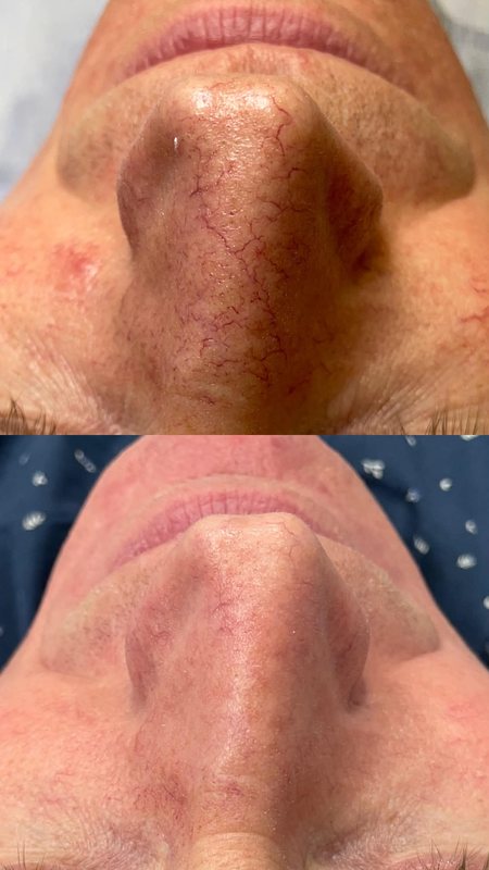 Naczynka na nosie przed i po 3 zabiegach światłem w Laser Clinic Radom