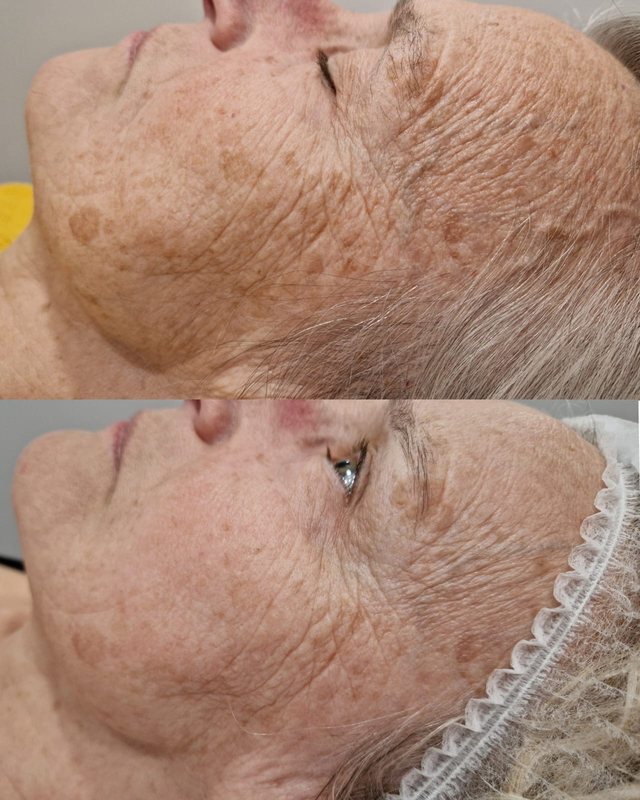Przebarwienia na twarzy przed i po 3 zabiegach światłem w Laser Clinic Radom