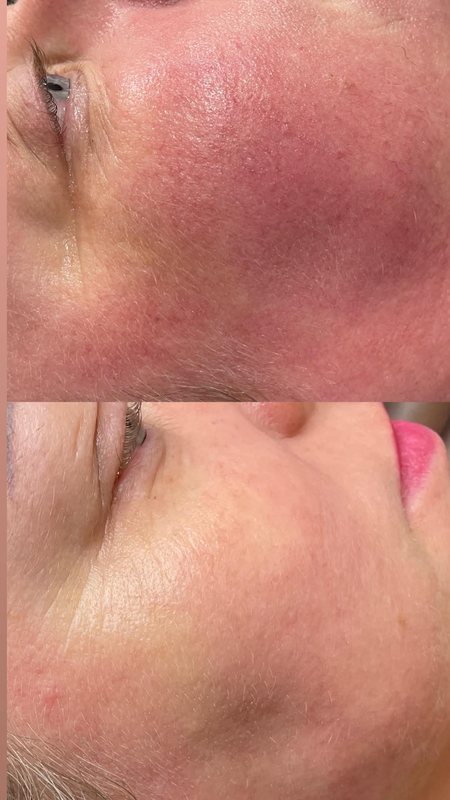 Rumień na policzku przed i po 3 zabiegach światłem w Laser Clinic Radom