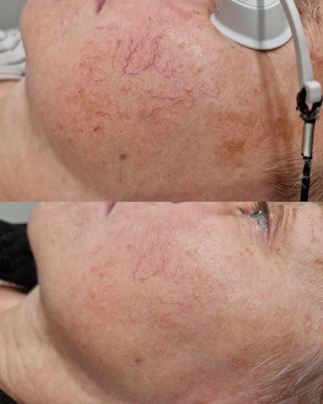Zamykanie naczynek na policzku w Laser Clinic Radom, efekt po jednym zabiegu światłem szerokopasmowym