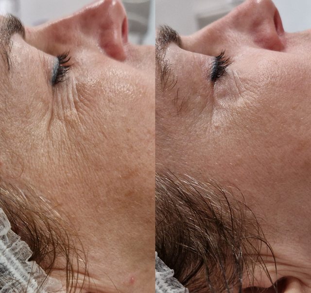 RFrax w Laser Clinic Radom, zmarszczki przy oku przed i po 3 zabiegach