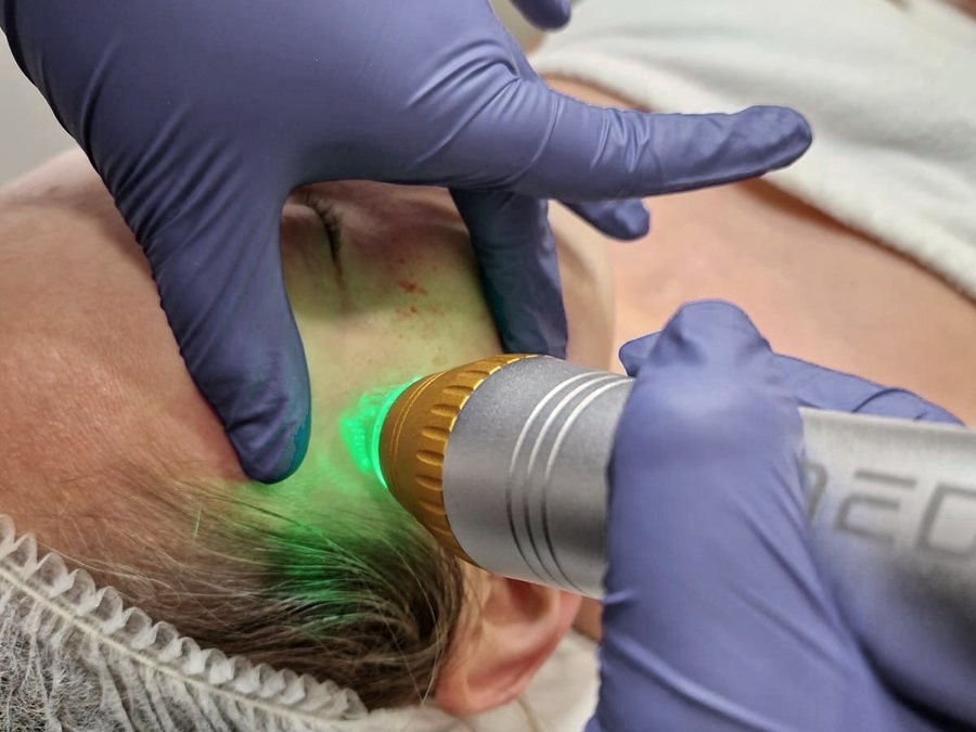 RFrax, frakcyjna radiofrekwencja mikroigłowa Medica w Laser Clinic Radom