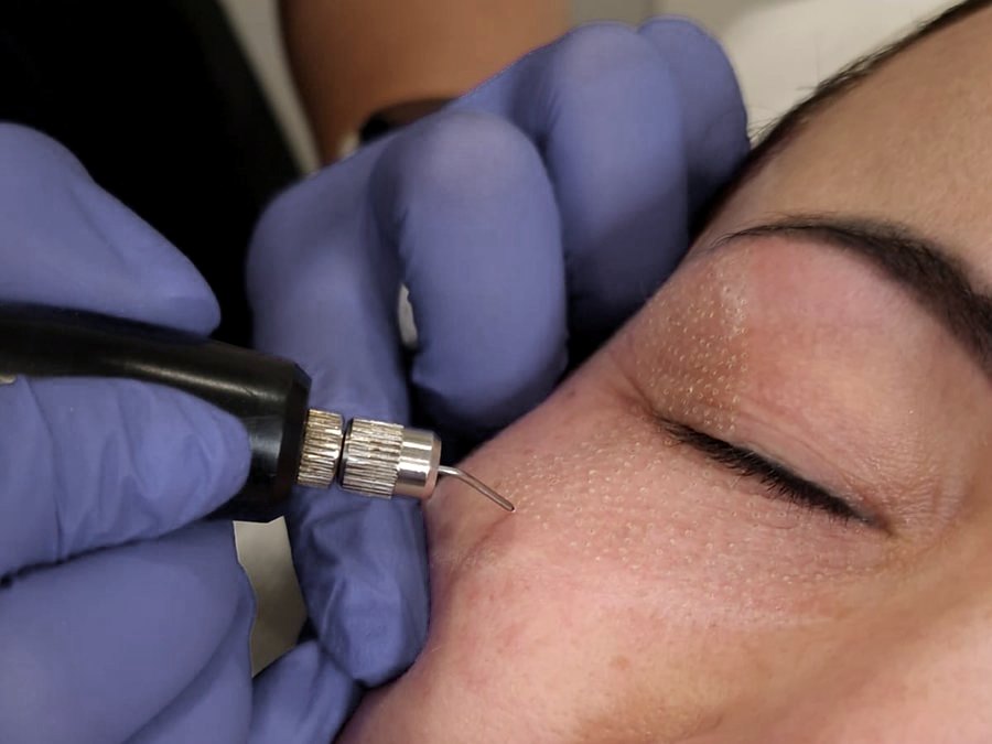 Plazma ARC, lifting powieki górnej w Laser Clinic Radom